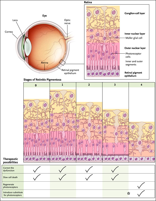 Tratamientos de la retinitis pigmentaria