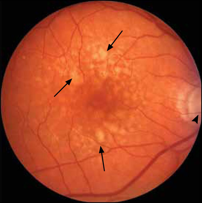Figura 1: vista oftalmoscópica de la retina y del nervio óptico en la degeneración macular relacionada con la edad (DMAE)