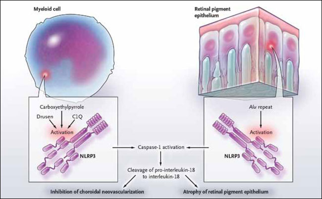 Figura 2: el inflamasoma NLRP3 y la DMAE